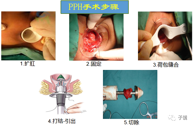 套扎环怎么下“中美专家谈内痔内镜下套扎治疗”学习笔记_https://www.jmylbn.com_新闻资讯_第15张