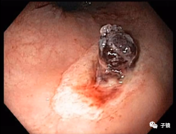 套扎环怎么下“中美专家谈内痔内镜下套扎治疗”学习笔记_https://www.jmylbn.com_新闻资讯_第8张