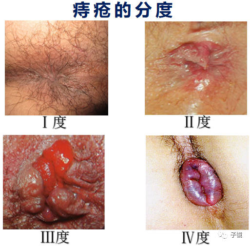 套扎环怎么下“中美专家谈内痔内镜下套扎治疗”学习笔记_https://www.jmylbn.com_新闻资讯_第13张