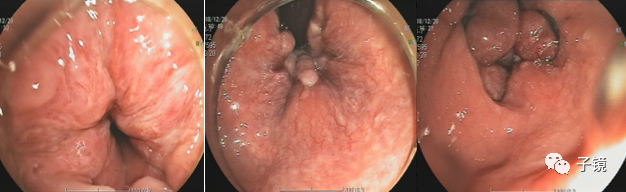 套扎环怎么下“中美专家谈内痔内镜下套扎治疗”学习笔记_https://www.jmylbn.com_新闻资讯_第20张