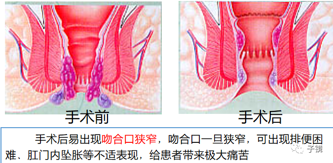 套扎环怎么下“中美专家谈内痔内镜下套扎治疗”学习笔记_https://www.jmylbn.com_新闻资讯_第16张