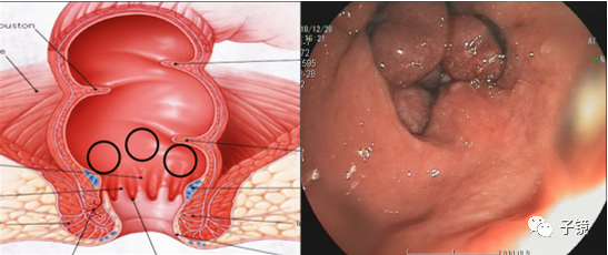 套扎环怎么下“中美专家谈内痔内镜下套扎治疗”学习笔记_https://www.jmylbn.com_新闻资讯_第24张