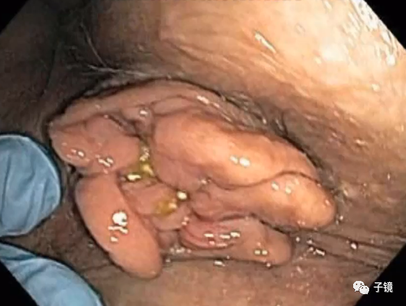 套扎环怎么下“中美专家谈内痔内镜下套扎治疗”学习笔记_https://www.jmylbn.com_新闻资讯_第4张