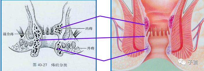 套扎环怎么下“中美专家谈内痔内镜下套扎治疗”学习笔记_https://www.jmylbn.com_新闻资讯_第12张