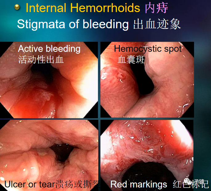 套扎环怎么下“中美专家谈内痔内镜下套扎治疗”学习笔记_https://www.jmylbn.com_新闻资讯_第6张