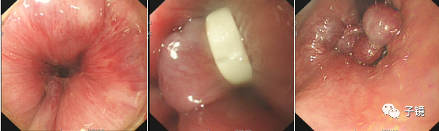 套扎环怎么下“中美专家谈内痔内镜下套扎治疗”学习笔记_https://www.jmylbn.com_新闻资讯_第19张