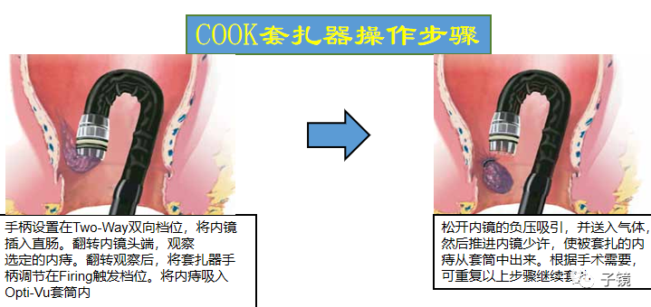 套扎环怎么下“中美专家谈内痔内镜下套扎治疗”学习笔记_https://www.jmylbn.com_新闻资讯_第17张