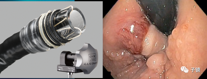 套扎环怎么下“中美专家谈内痔内镜下套扎治疗”学习笔记_https://www.jmylbn.com_新闻资讯_第7张