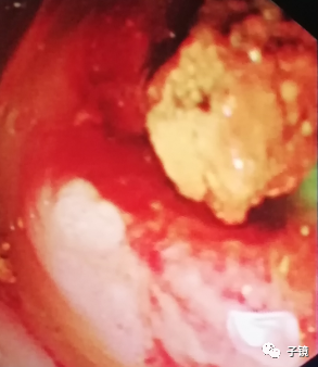取石球囊怎么取石“ERCP球囊取石细节讨论”学习笔记_https://www.jmylbn.com_新闻资讯_第8张