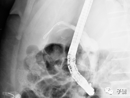 取石球囊怎么取石“ERCP球囊取石细节讨论”学习笔记_https://www.jmylbn.com_新闻资讯_第5张