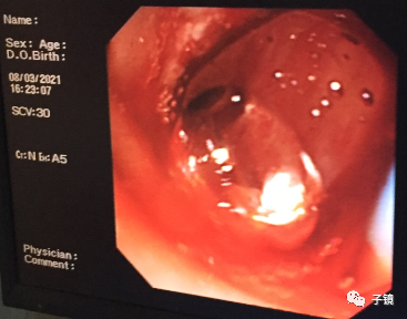 取石球囊怎么取石“ERCP球囊取石细节讨论”学习笔记_https://www.jmylbn.com_新闻资讯_第6张