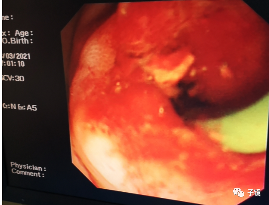 取石球囊怎么取石“ERCP球囊取石细节讨论”学习笔记_https://www.jmylbn.com_新闻资讯_第11张