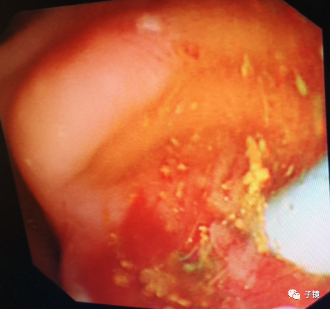 取石球囊怎么取石“ERCP球囊取石细节讨论”学习笔记_https://www.jmylbn.com_新闻资讯_第10张