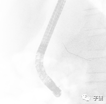 取石球囊怎么取石“ERCP球囊取石细节讨论”学习笔记_https://www.jmylbn.com_新闻资讯_第4张