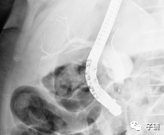 取石球囊怎么取石“ERCP球囊取石细节讨论”学习笔记_https://www.jmylbn.com_新闻资讯_第7张