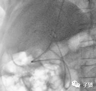 取石球囊怎么取石“ERCP球囊取石细节讨论”学习笔记_https://www.jmylbn.com_新闻资讯_第12张