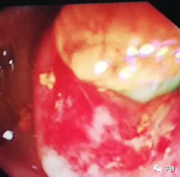 取石球囊怎么取石“ERCP球囊取石细节讨论”学习笔记_https://www.jmylbn.com_新闻资讯_第9张