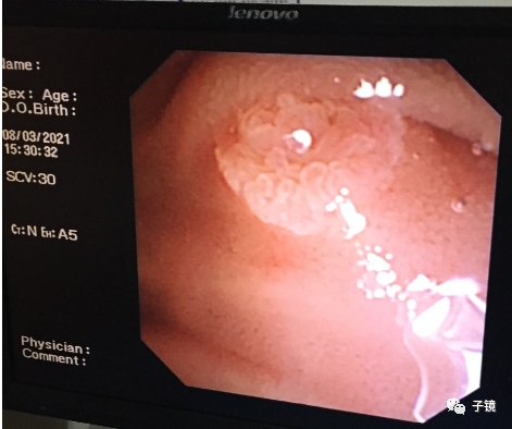 取石球囊怎么取石“ERCP球囊取石细节讨论”学习笔记_https://www.jmylbn.com_新闻资讯_第3张
