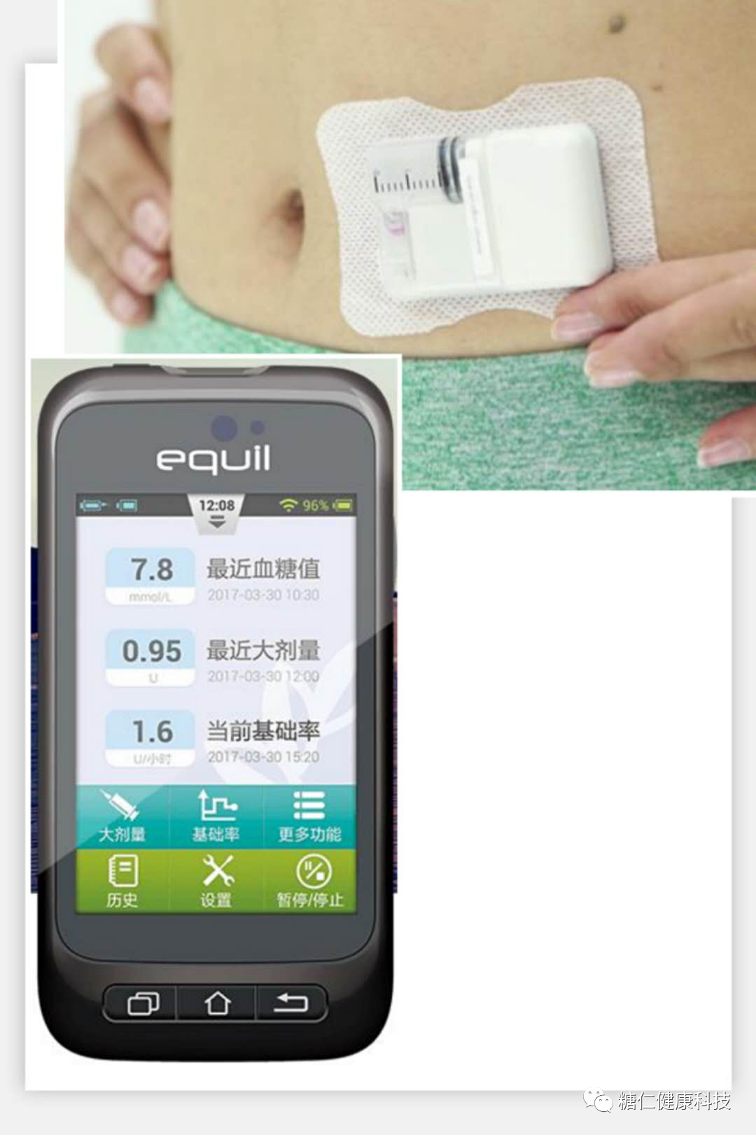 微泰胰岛素泵怎么样国内市场常见胰岛素泵大PK_https://www.jmylbn.com_新闻资讯_第8张