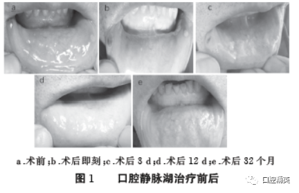 口腔激光怎么治疗半导体激光舒适化治疗口腔静脉湖伴口腔溃疡1例_https://www.jmylbn.com_新闻资讯_第4张