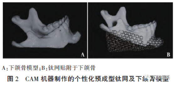 三维钛网是什么CAD／CAM制作个性化钛网联合髂骨移植重建单侧下颌骨大型轮廓缺损_https://www.jmylbn.com_新闻资讯_第5张