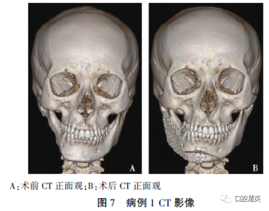 三维钛网是什么CAD／CAM制作个性化钛网联合髂骨移植重建单侧下颌骨大型轮廓缺损_https://www.jmylbn.com_新闻资讯_第10张