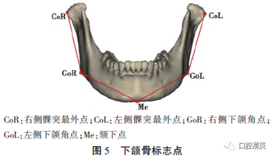 三维钛网是什么CAD／CAM制作个性化钛网联合髂骨移植重建单侧下颌骨大型轮廓缺损_https://www.jmylbn.com_新闻资讯_第8张