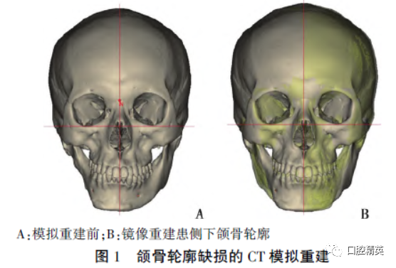 三维钛网是什么CAD／CAM制作个性化钛网联合髂骨移植重建单侧下颌骨大型轮廓缺损_https://www.jmylbn.com_新闻资讯_第4张