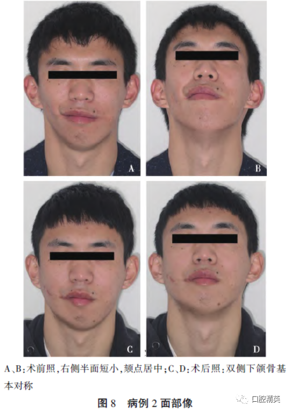 三维钛网是什么CAD／CAM制作个性化钛网联合髂骨移植重建单侧下颌骨大型轮廓缺损_https://www.jmylbn.com_新闻资讯_第11张