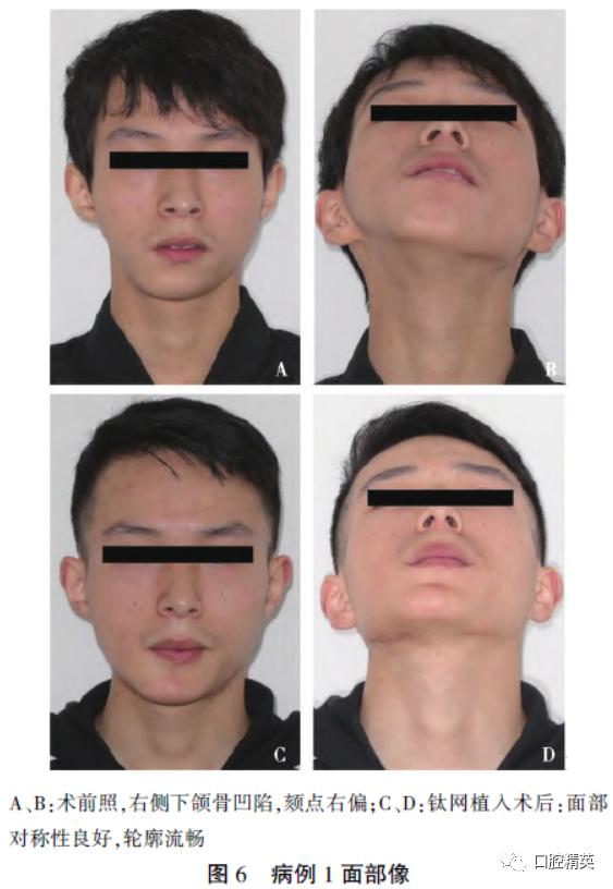 三维钛网是什么CAD／CAM制作个性化钛网联合髂骨移植重建单侧下颌骨大型轮廓缺损_https://www.jmylbn.com_新闻资讯_第9张