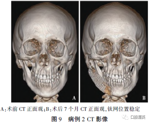 三维钛网是什么CAD／CAM制作个性化钛网联合髂骨移植重建单侧下颌骨大型轮廓缺损_https://www.jmylbn.com_新闻资讯_第12张