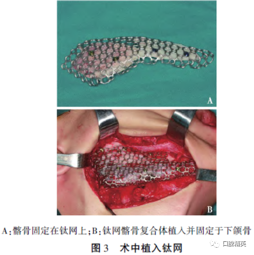 三维钛网是什么CAD／CAM制作个性化钛网联合髂骨移植重建单侧下颌骨大型轮廓缺损_https://www.jmylbn.com_新闻资讯_第6张