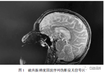 金属桩核冠引起巨大磁共振伪影致牙齿拔除1例