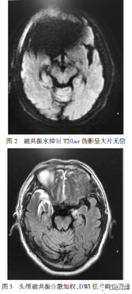 金属桩核冠引起巨大磁共振伪影致牙齿拔除1例