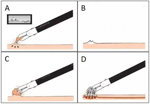 为什么说热活检钳​肠息肉切除术的一般步骤，5张图片教会你_https://www.jmylbn.com_新闻资讯_第4张