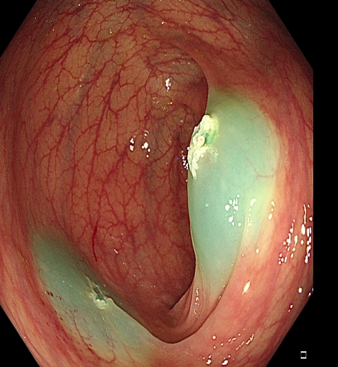为什么说热活检钳​肠息肉切除术的一般步骤，5张图片教会你_https://www.jmylbn.com_新闻资讯_第12张