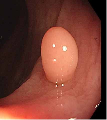 为什么说热活检钳​肠息肉切除术的一般步骤，5张图片教会你_https://www.jmylbn.com_新闻资讯_第5张