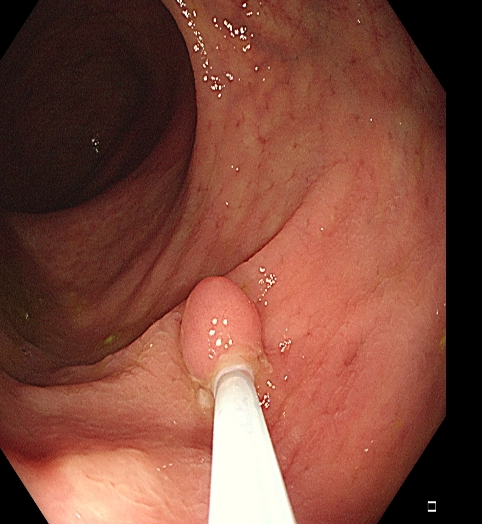 为什么说热活检钳​肠息肉切除术的一般步骤，5张图片教会你_https://www.jmylbn.com_新闻资讯_第6张