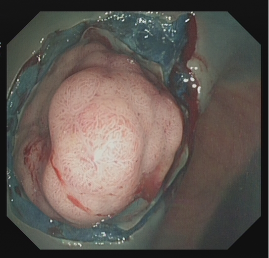 为什么说热活检钳​肠息肉切除术的一般步骤，5张图片教会你_https://www.jmylbn.com_新闻资讯_第21张