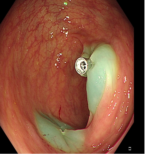为什么说热活检钳​肠息肉切除术的一般步骤，5张图片教会你_https://www.jmylbn.com_新闻资讯_第13张