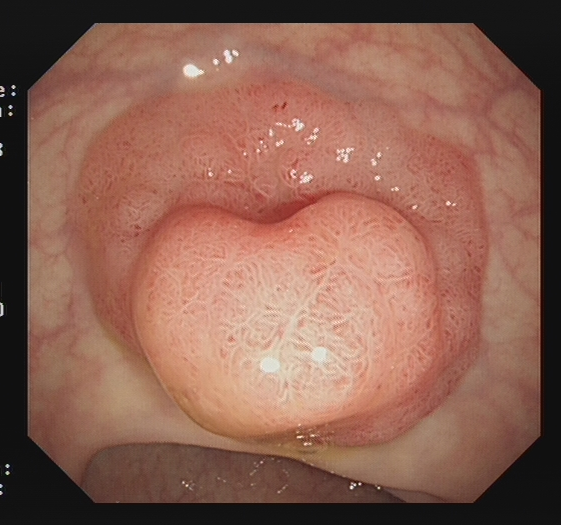 为什么说热活检钳​肠息肉切除术的一般步骤，5张图片教会你_https://www.jmylbn.com_新闻资讯_第19张