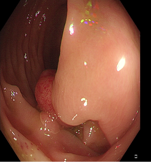 为什么说热活检钳​肠息肉切除术的一般步骤，5张图片教会你_https://www.jmylbn.com_新闻资讯_第9张
