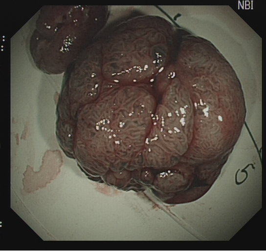 为什么说热活检钳​肠息肉切除术的一般步骤，5张图片教会你_https://www.jmylbn.com_新闻资讯_第23张