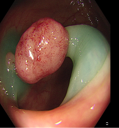 为什么说热活检钳​肠息肉切除术的一般步骤，5张图片教会你_https://www.jmylbn.com_新闻资讯_第10张