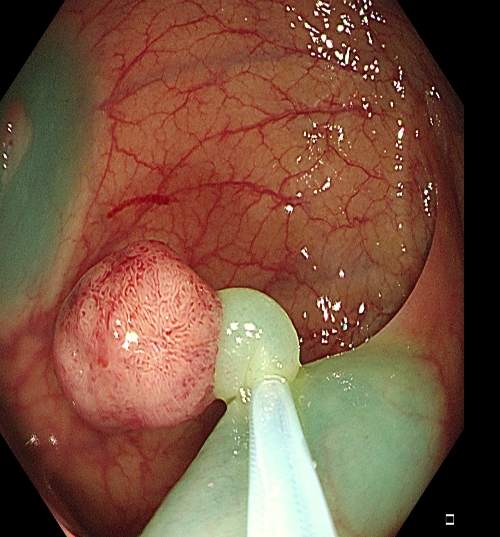 为什么说热活检钳​肠息肉切除术的一般步骤，5张图片教会你_https://www.jmylbn.com_新闻资讯_第11张