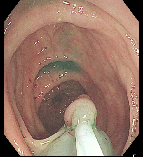 为什么说热活检钳​肠息肉切除术的一般步骤，5张图片教会你_https://www.jmylbn.com_新闻资讯_第16张