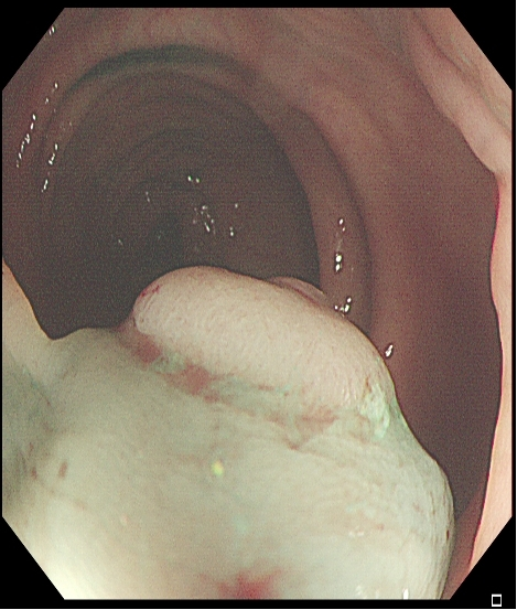 为什么说热活检钳​肠息肉切除术的一般步骤，5张图片教会你_https://www.jmylbn.com_新闻资讯_第15张