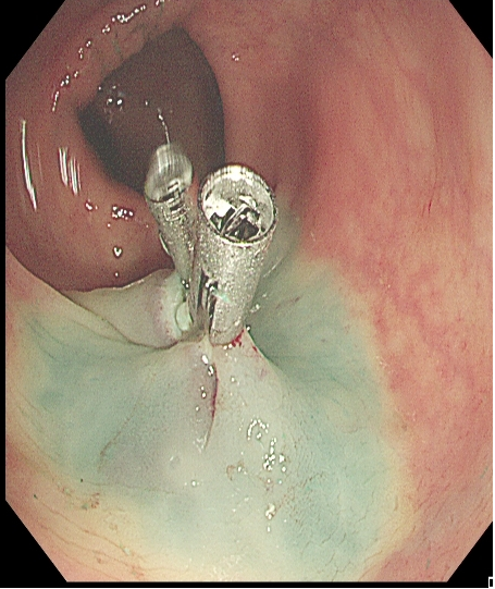为什么说热活检钳​肠息肉切除术的一般步骤，5张图片教会你_https://www.jmylbn.com_新闻资讯_第18张