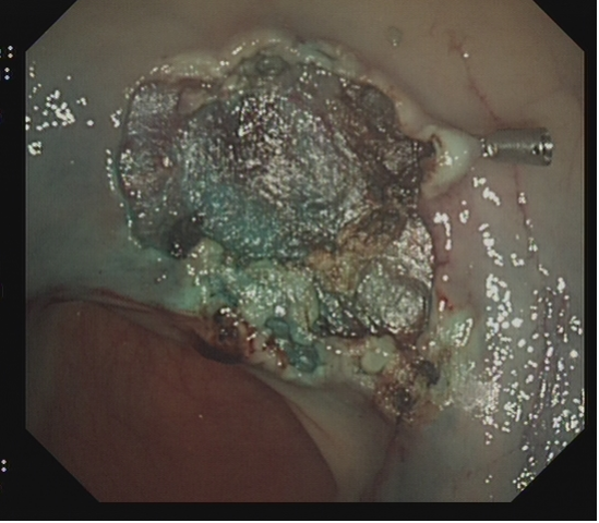 为什么说热活检钳​肠息肉切除术的一般步骤，5张图片教会你_https://www.jmylbn.com_新闻资讯_第22张