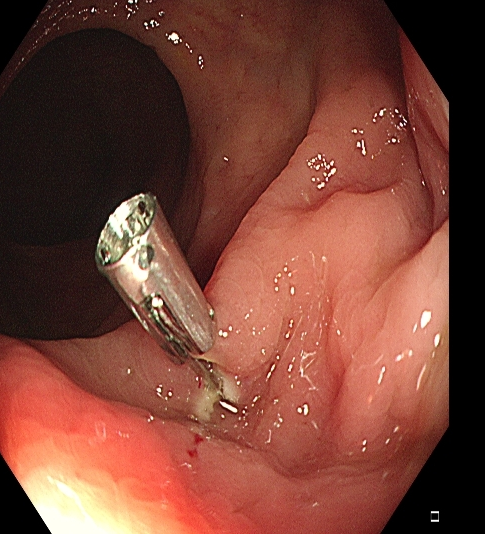 为什么说热活检钳​肠息肉切除术的一般步骤，5张图片教会你_https://www.jmylbn.com_新闻资讯_第8张